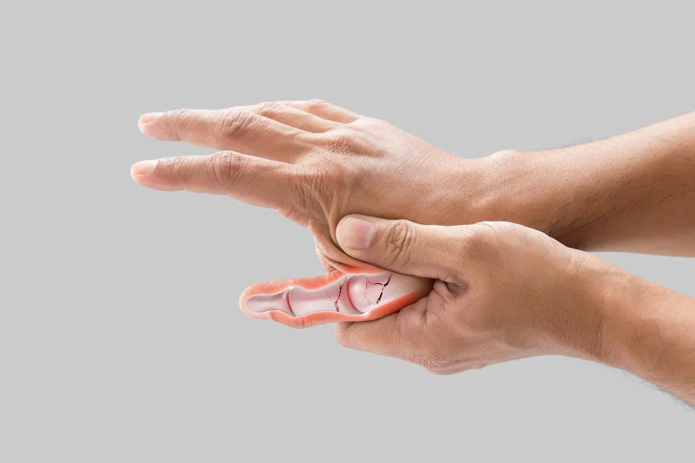 Dislocating a Finger: What You Need to Know and When to Seek Help