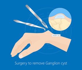 Ganglion Cyst surgery
