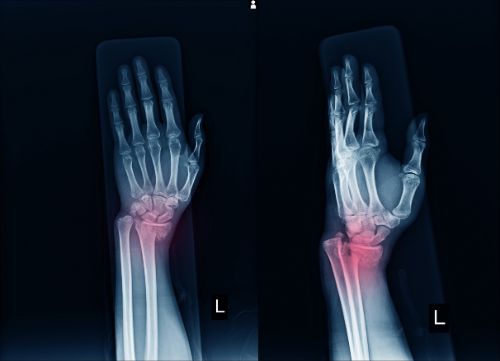 Xray of a wrist fracture